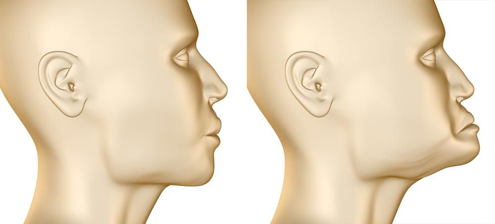 Before and after jaw bone loss